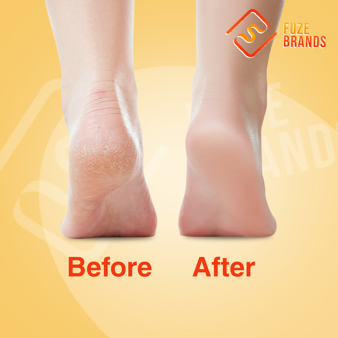 Glass Callus Remover for Feet, Skin Remover, Nano Glass Foot File, Dead  Skin Remover, Heel Scraper and Foot Scrubber in Shower, Dead Skin Remover