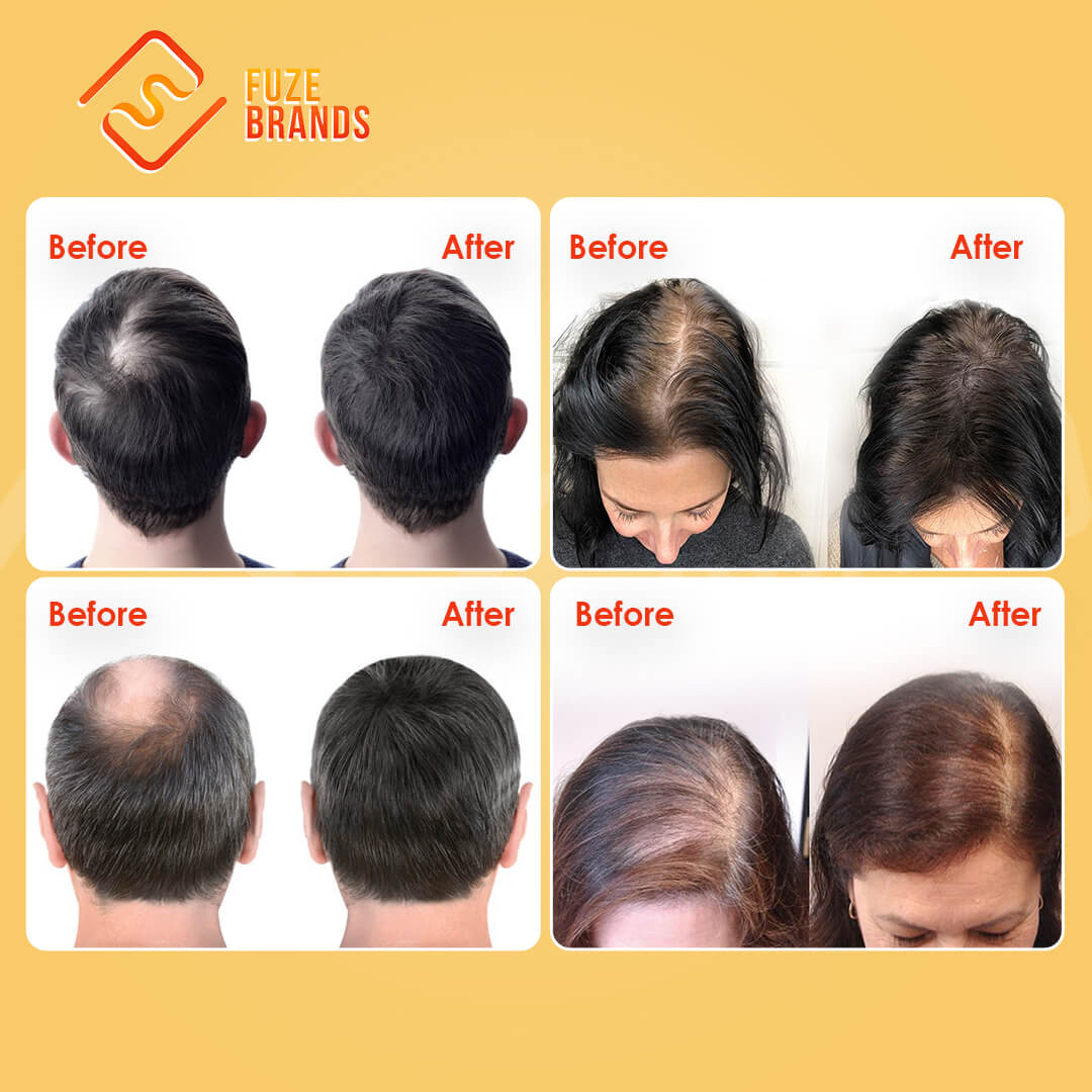 HairThetica™ - Professional Laser Hat For Hair Growth